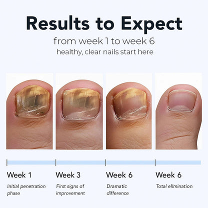ZeroFungex™ Anti-Fungal Nail Repair Patches