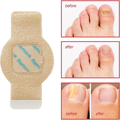 ZeroFungex™ Anti-Fungal Nail Repair Patches