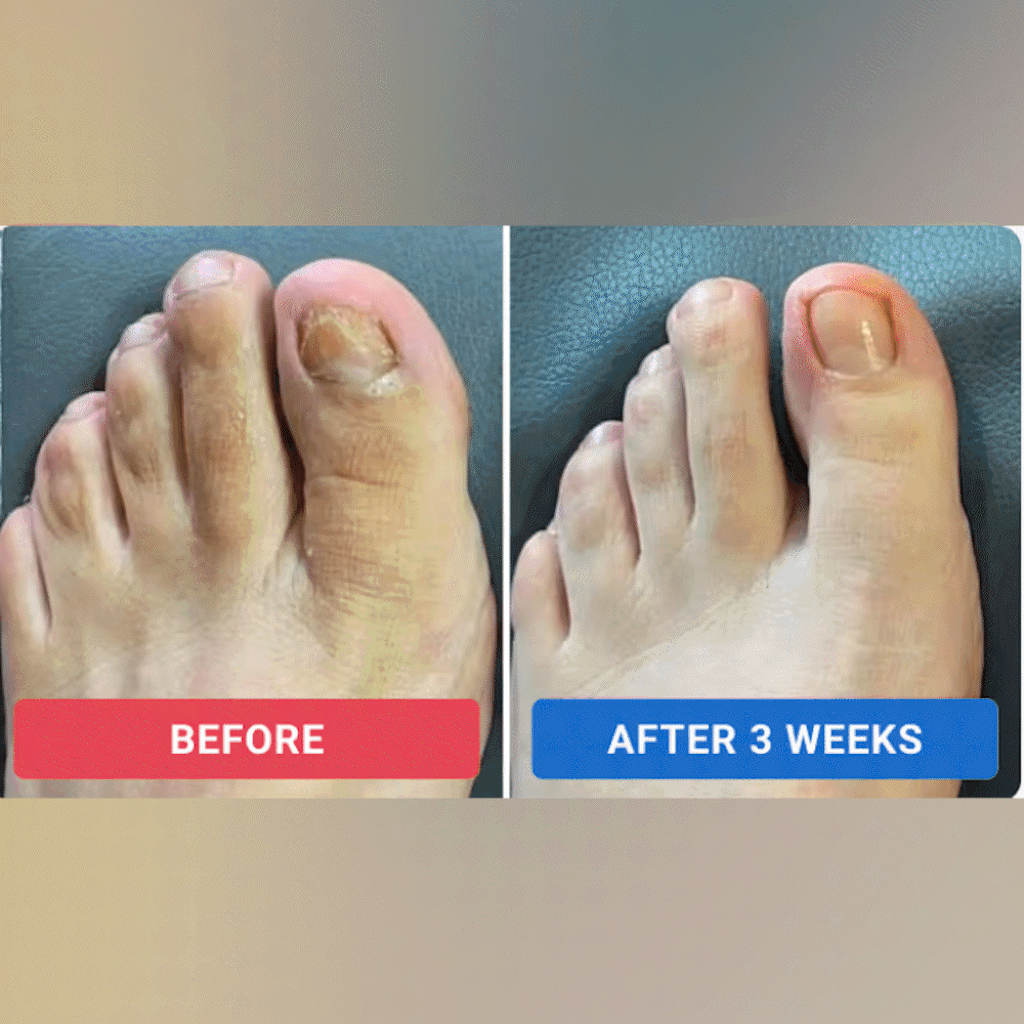 ZeroFungex™ Anti-Fungal Nail Repair Patches